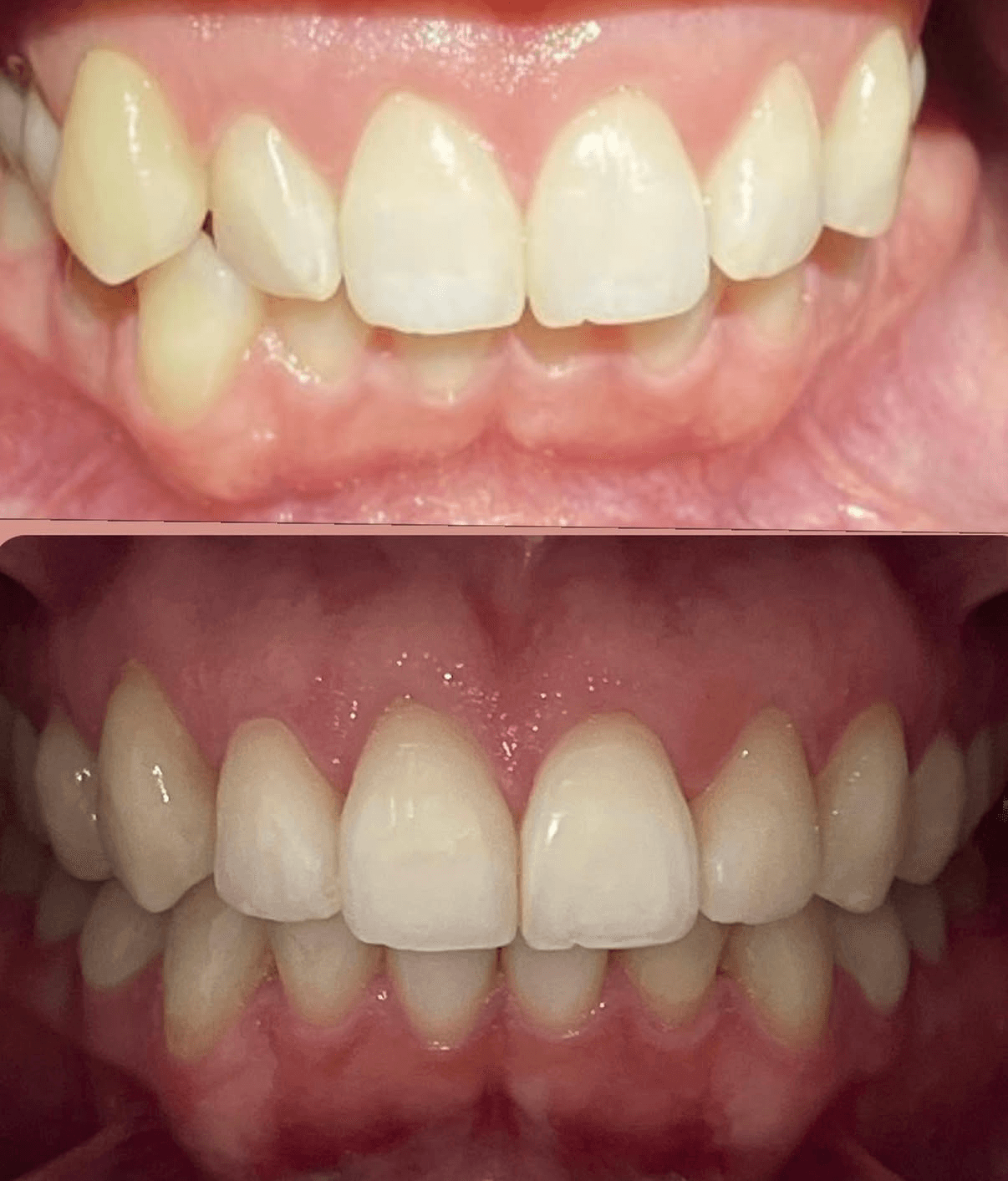 Invisalign in Kirkland, WA: Cost, Process & What to Expect