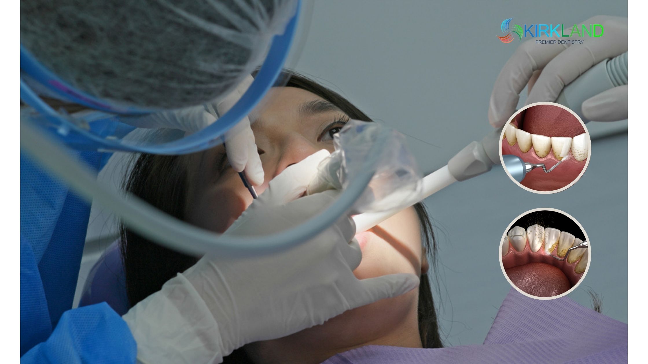 How Often Should You Get Teeth Scaling Done