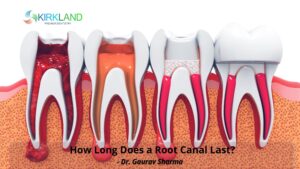 How Long Does a Root Canal Last?