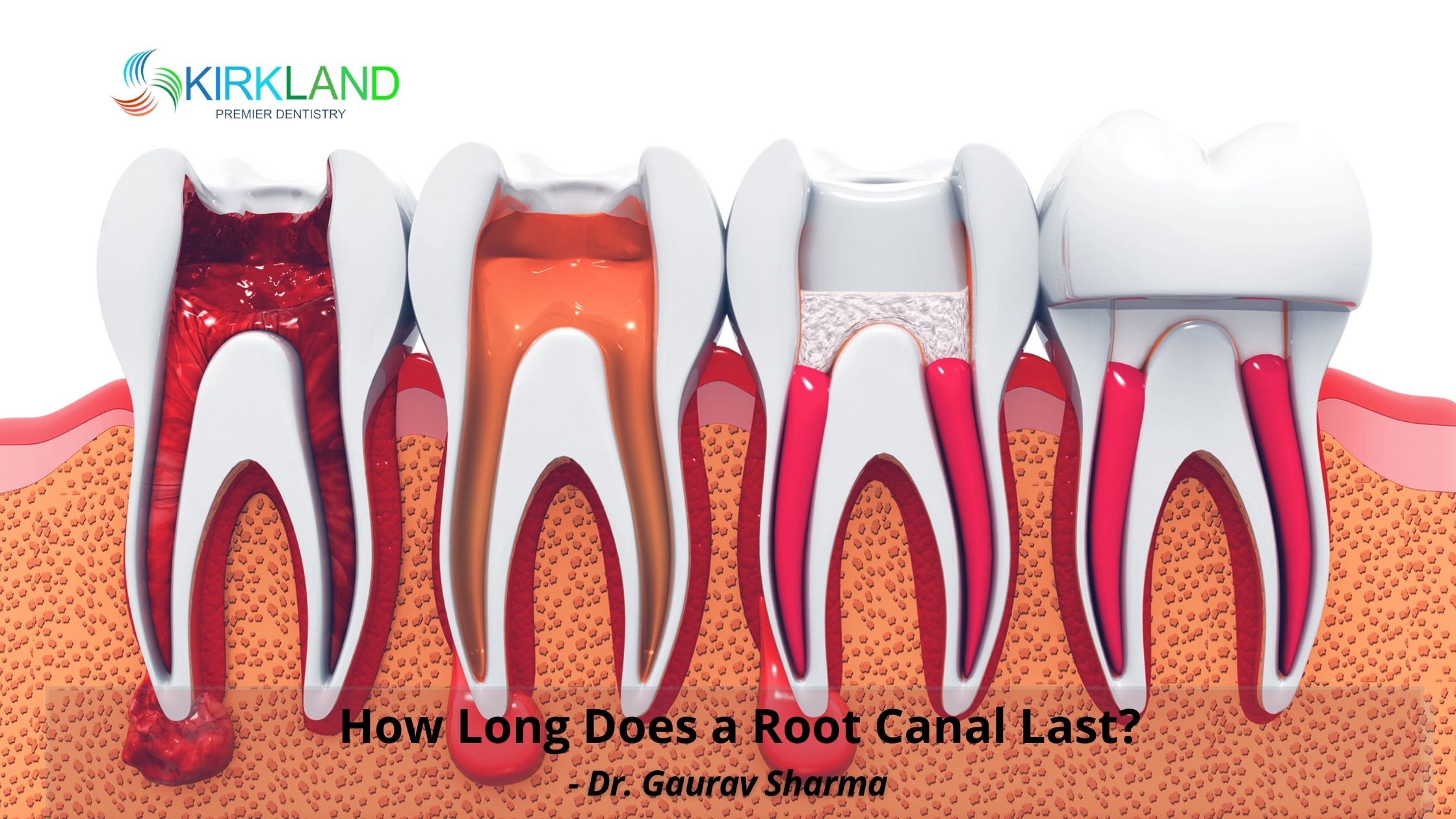How Long Does a Root Canal Last?