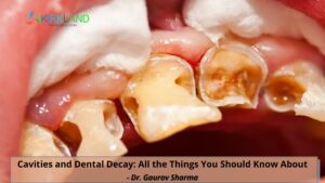 Cavity and Dental Decay