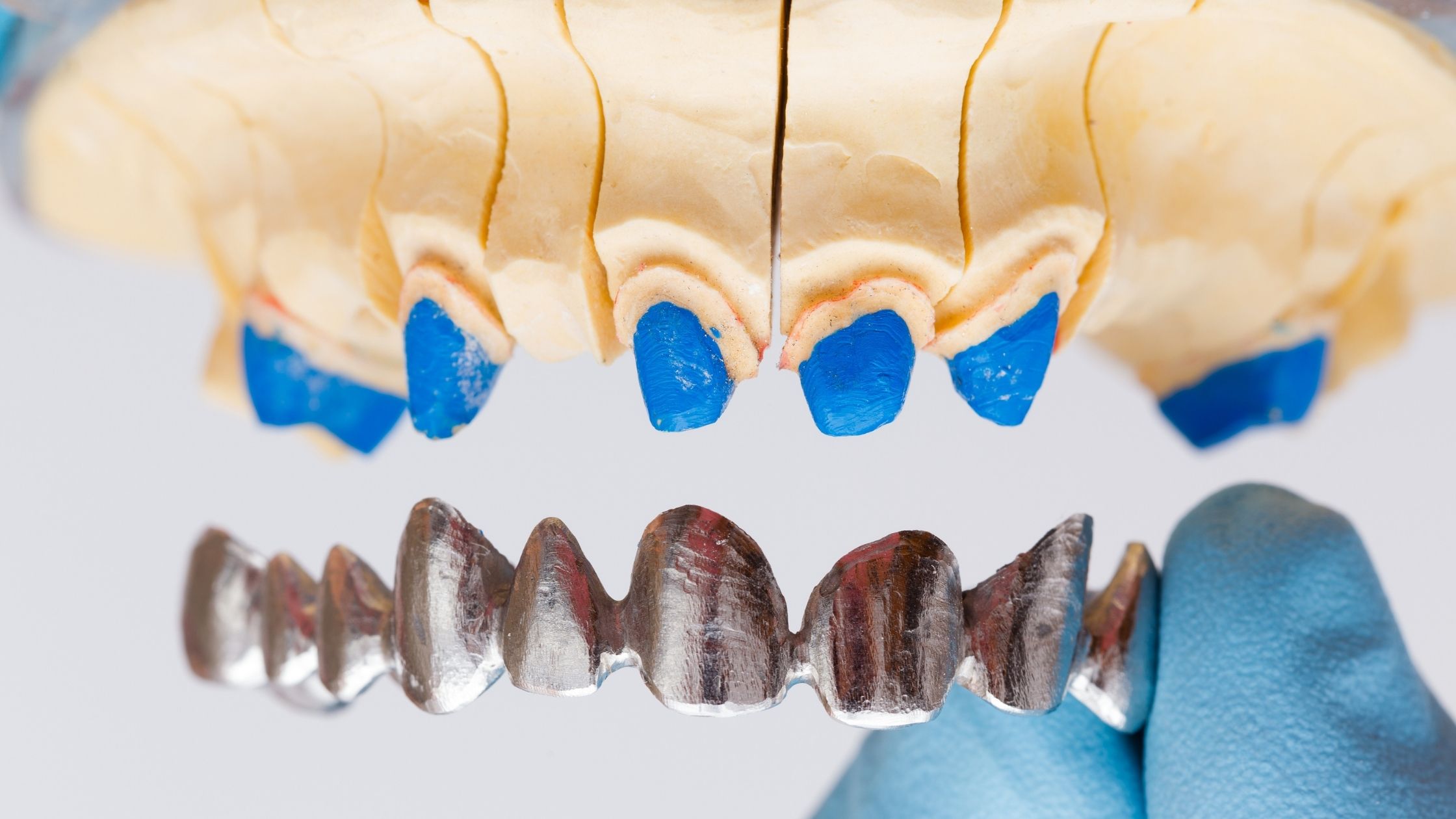 Dental Crowns