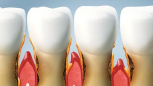Gums Disease