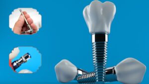 Dental Implants Material