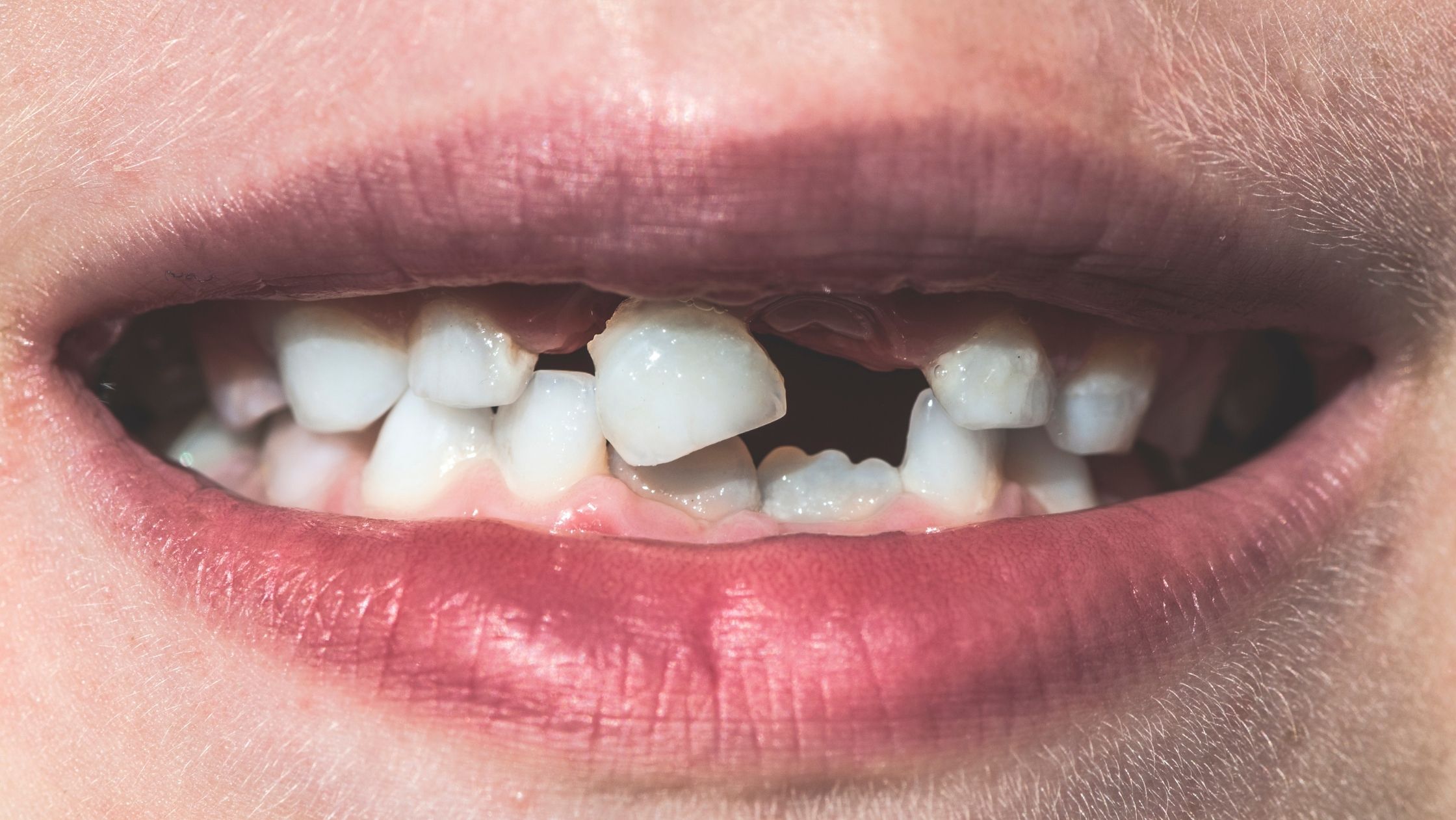 Dental Implants and Facial Structure