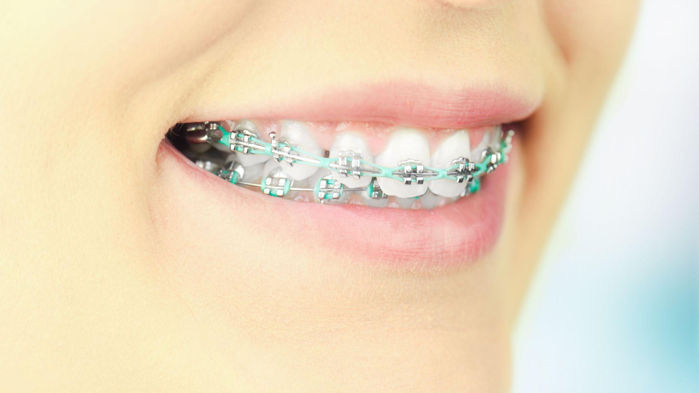 Orthodontic Treatments