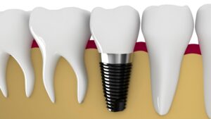 Dental Implants