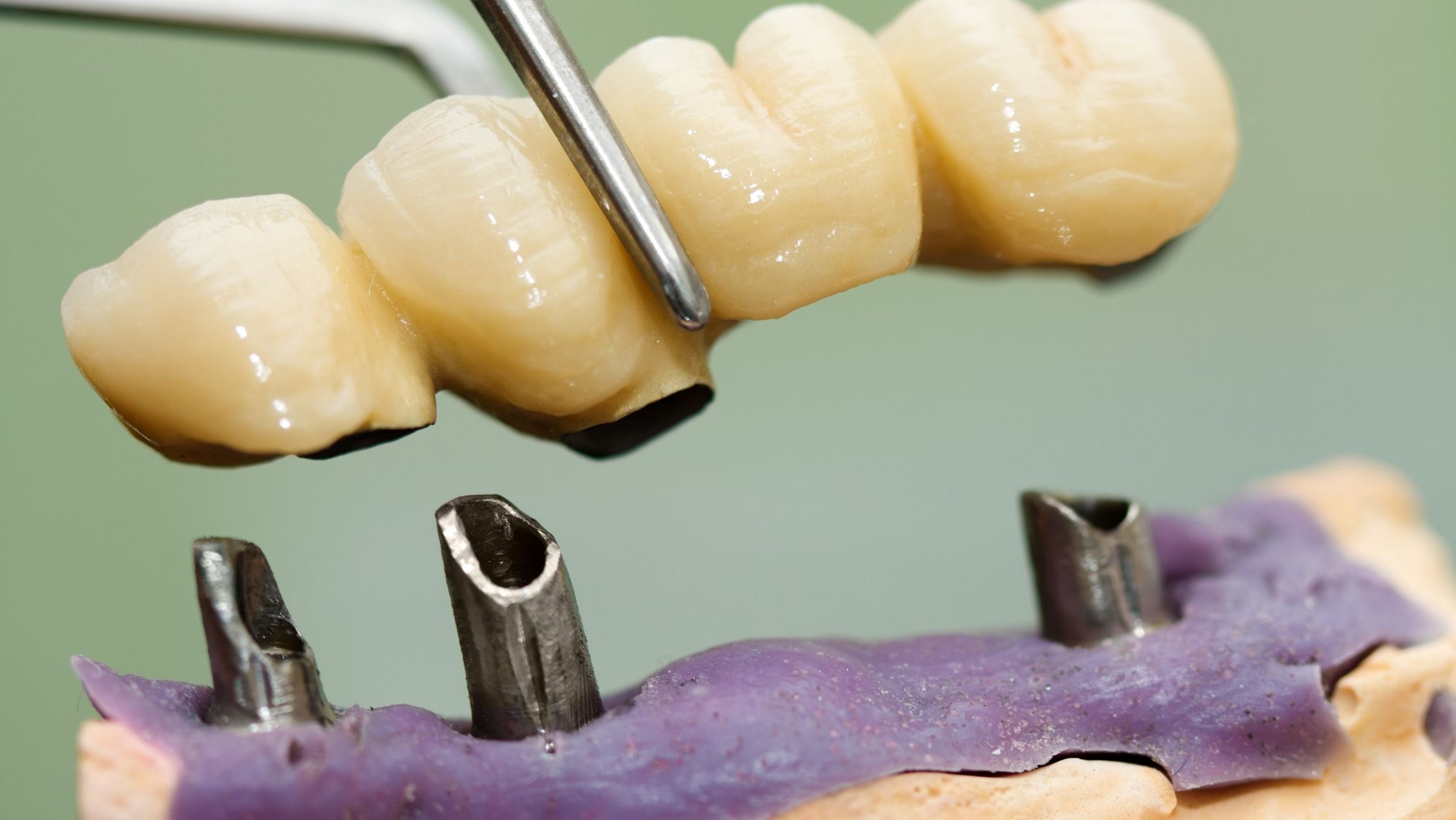 Dental Implant Vs. Bridge Which One Is the Best Option for You