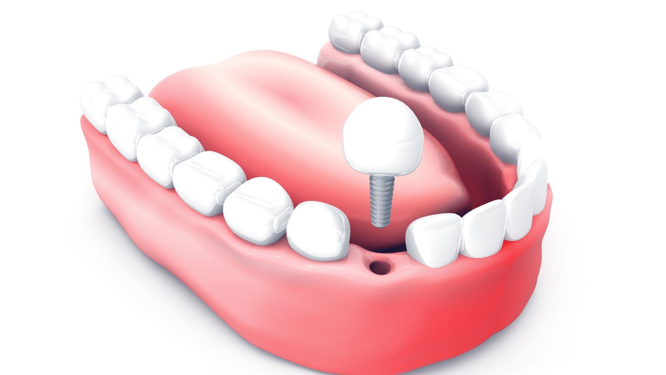 Mini dental implants