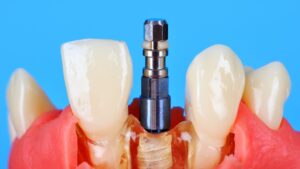 Mini dental implants