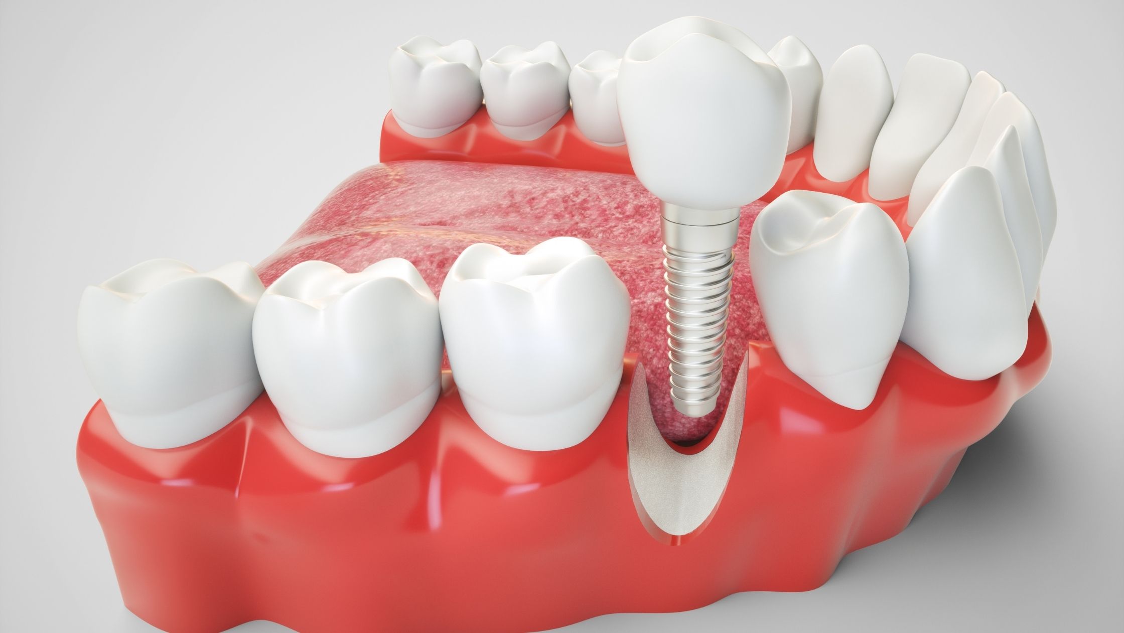 Are Dental implants Painful