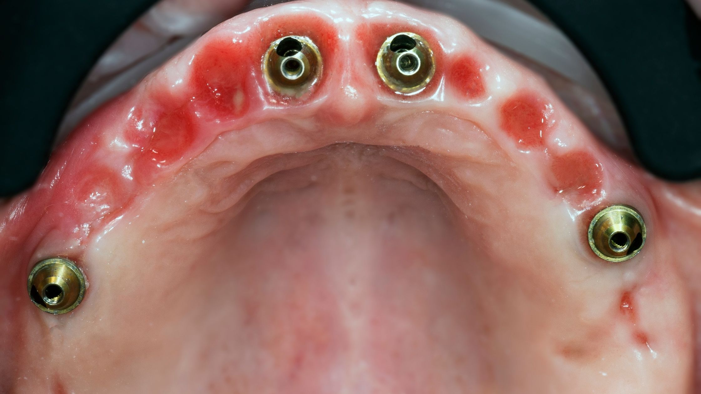 All-on-4 Dental Implants