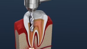 Root Canal