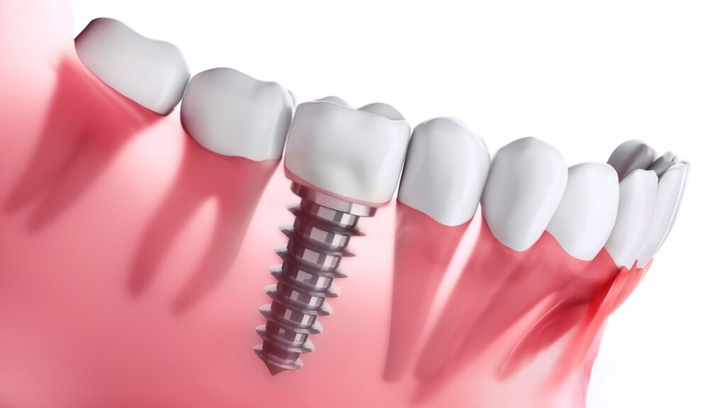 Full Mouth Dental Implants Types and Procedure Kirkland Premier