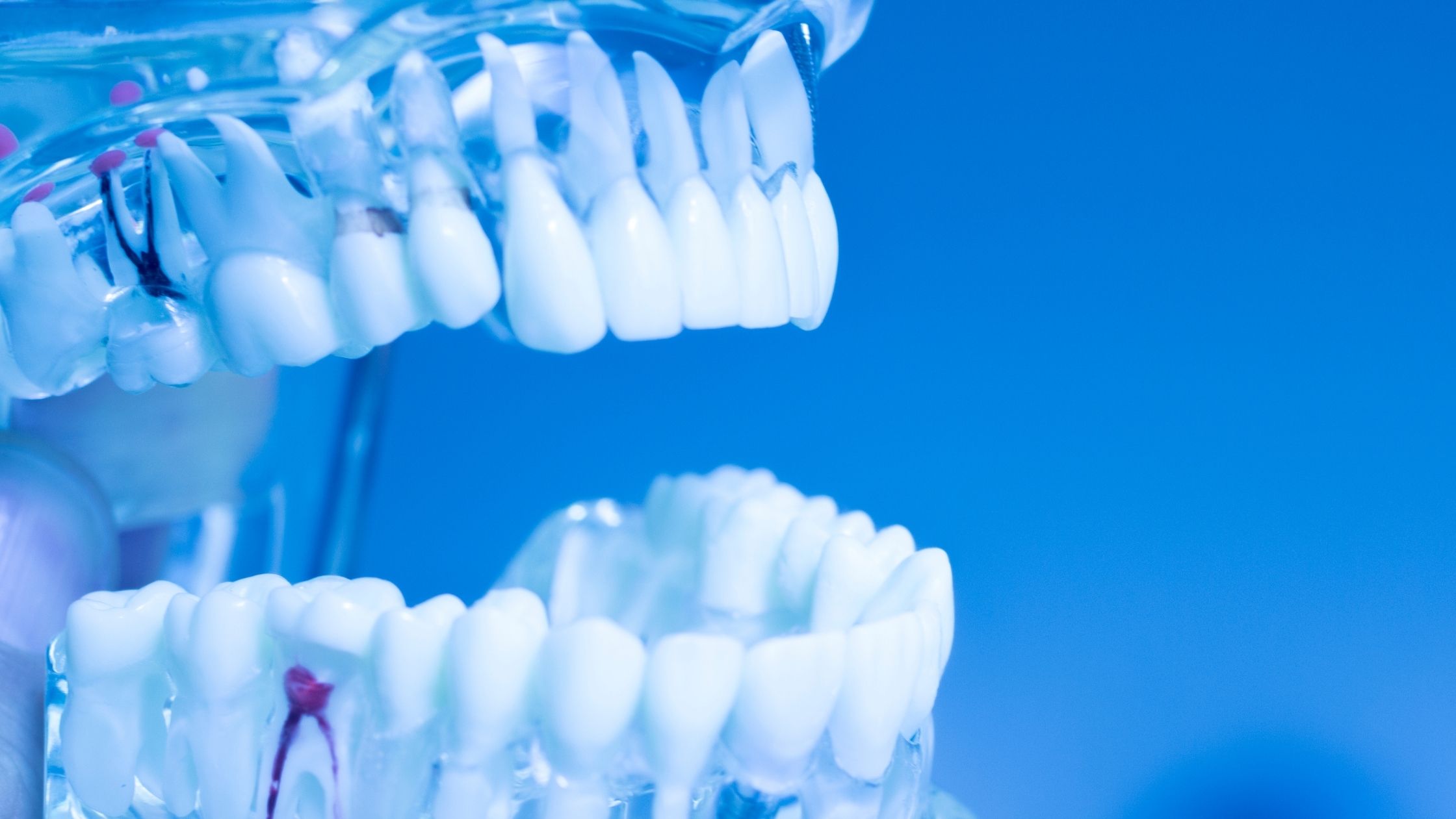 Full Mouth Dental Implants