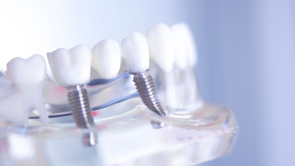 Everything You Need to Know About AllOnX Dental Implants? Kirkland