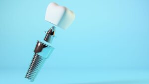 Dental Implants