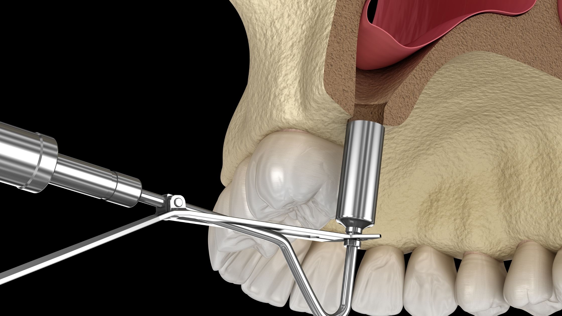 Sinus Lift Surgery