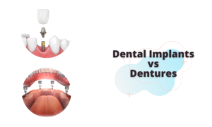 dental implants vs dentures