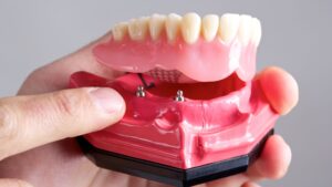 Molar Dental Implants