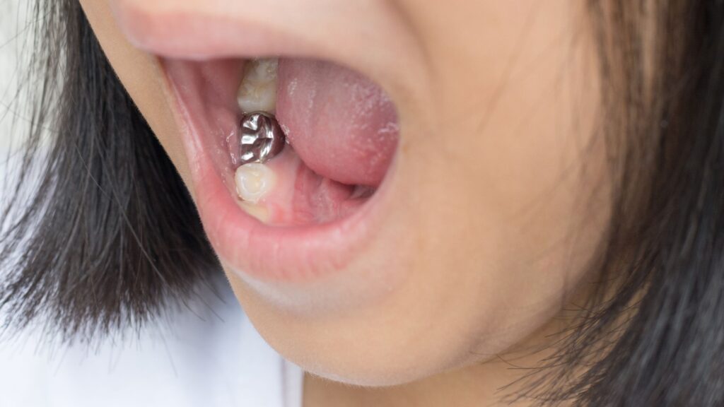 What is Amalgam Silver Coloured Fillings Kirkland Premier Dentistry
