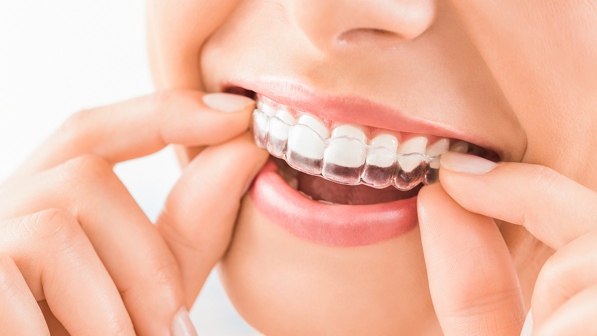 Clear Braces Myths