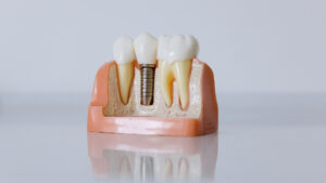 best-implants-dentist-kirland-premier-dentist