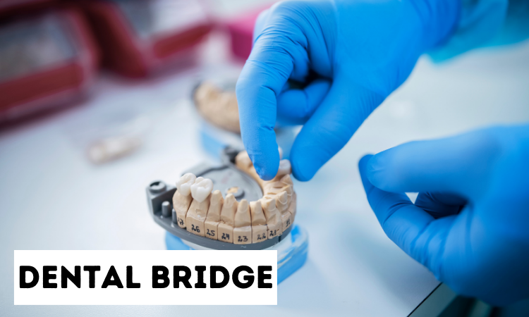 dental bridge