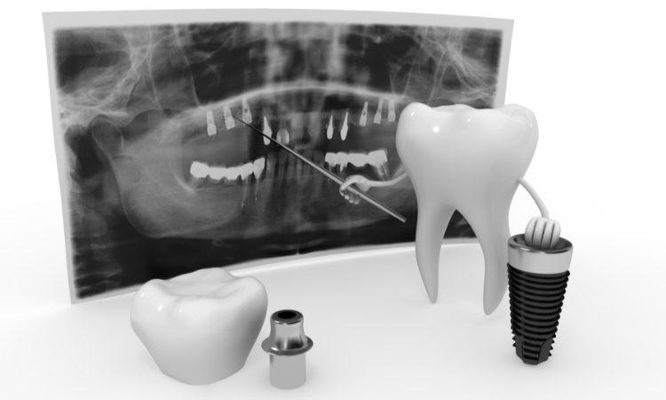 Full arch dental implants