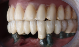 All-on-6 Dental Implants