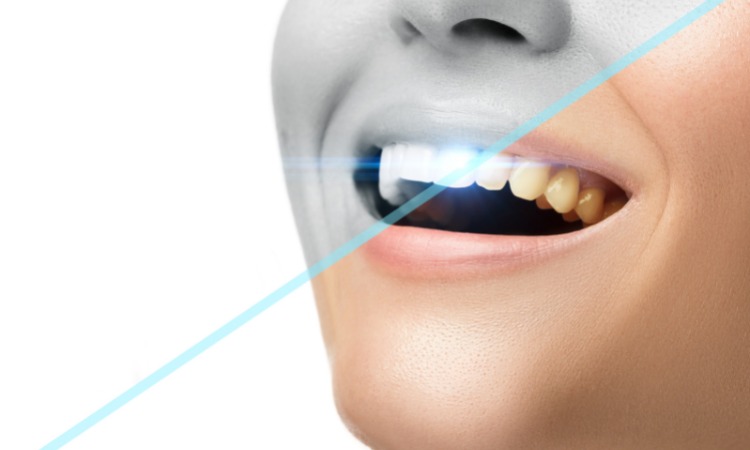 How To Get Whiter Teeth at Kirkland Premier Dentistry: A Simple Guide for teeth whitening