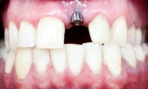 The Ultimate guide to All on 4 Dental implants cost