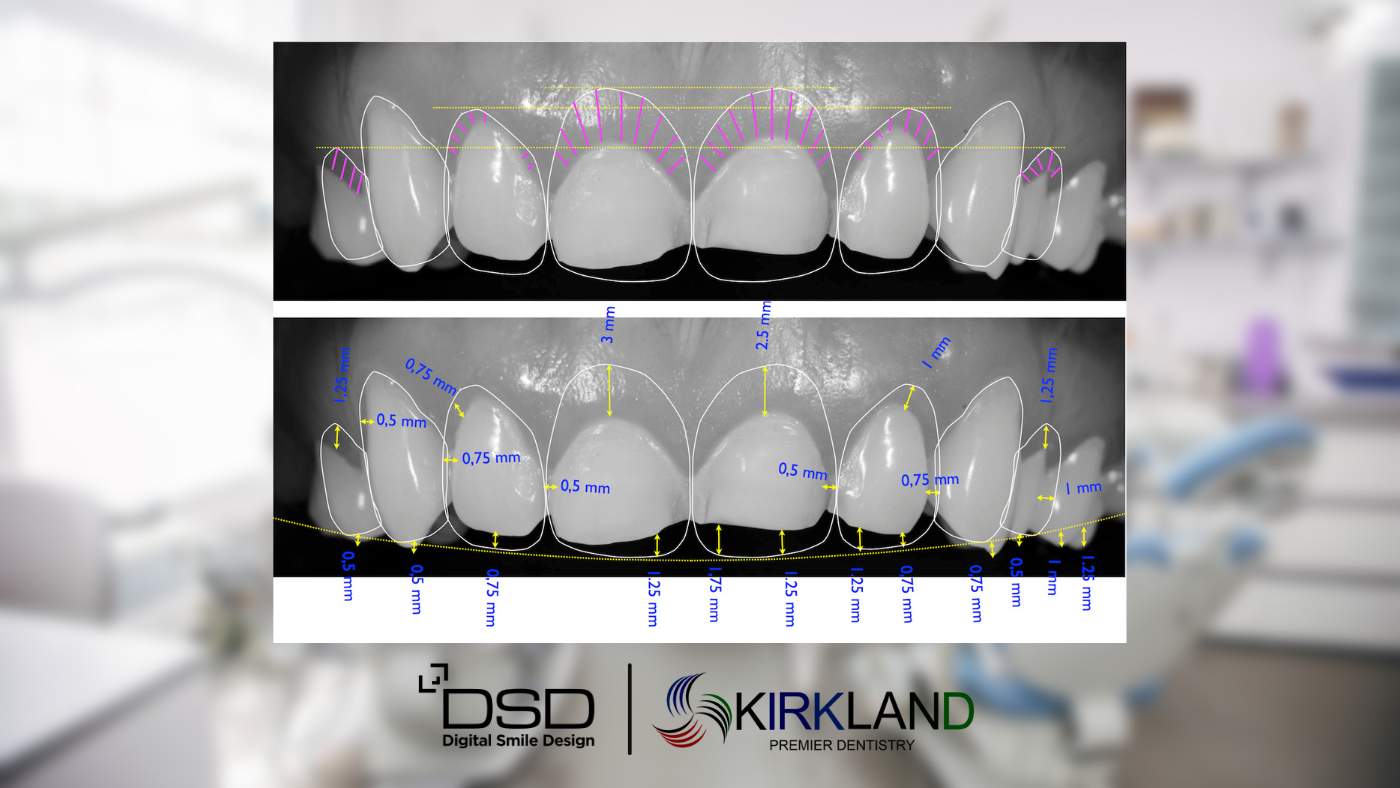 digital smile design