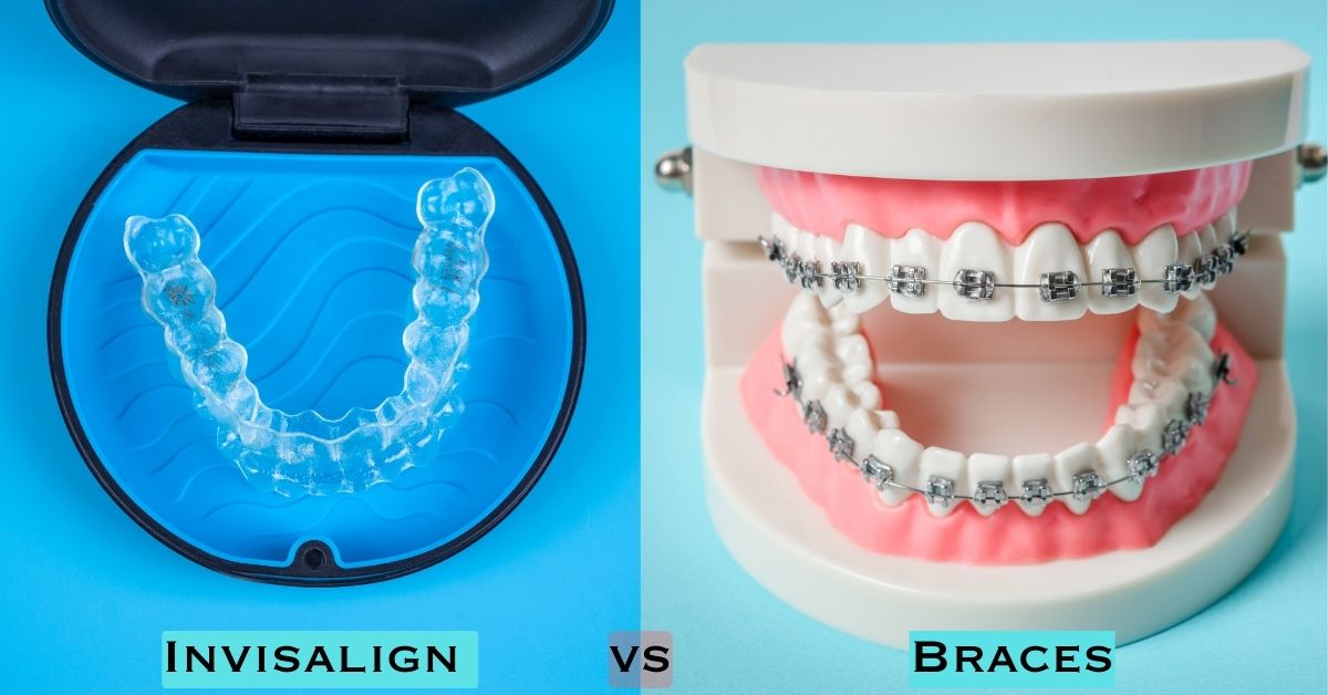 Comparing Invisalign vs Braces for Teenagers Overbite Treatment and
