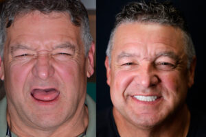 Cracked and Broken Tooth