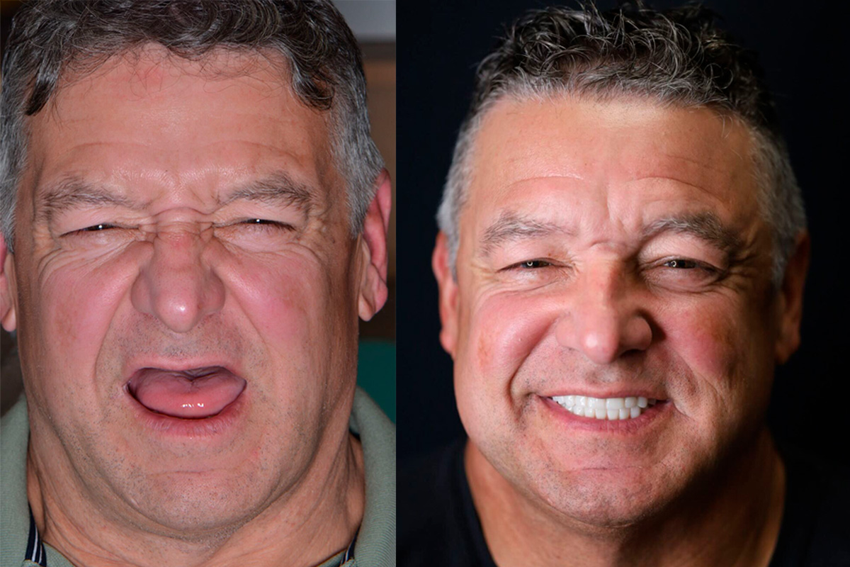 Cracked and Broken Tooth