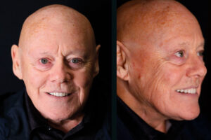 Mike’s Smile Transformation