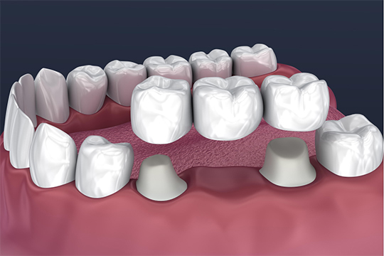 Crowns And Dental Bridges